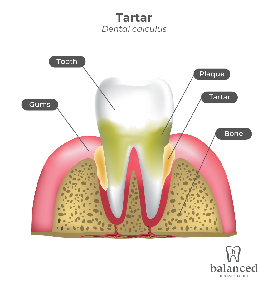 what is tartar on teeth?