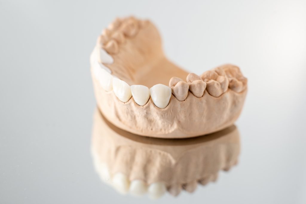 Model of artificial jaw with veneers