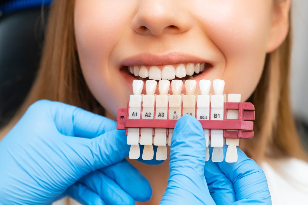 Set various shades of tone for whitening of teeth and perfect woman smile