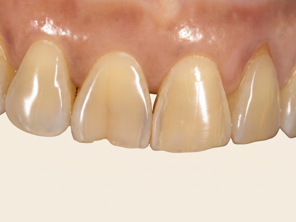 chipped front tooth